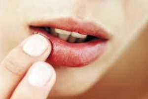 Bị nhiệt miệng dùng cây thuốc nào để giúp điều trị hiệu quả ?