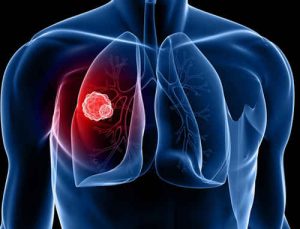 Ung thư biểu mô phổi có dùng cây xạ đen được không ?