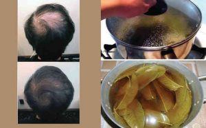 Cách giúp điều trị rụng tóc bằng lá ổi đơn giản hiệu quả cao